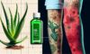 Burn Treatment Essentials: Key Steps for Effective Care